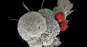 A pseudo-colored scanning electron micrograph of an oral squamous cancer cell (white) being attacked by two cytotoxic T cells (red).