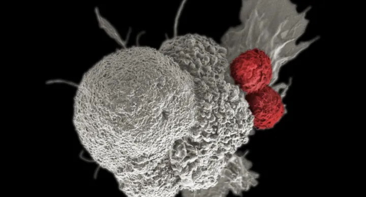 A pseudo-colored scanning electron micrograph of an oral squamous cancer cell (white) being attacked by two cytotoxic T cells (red).